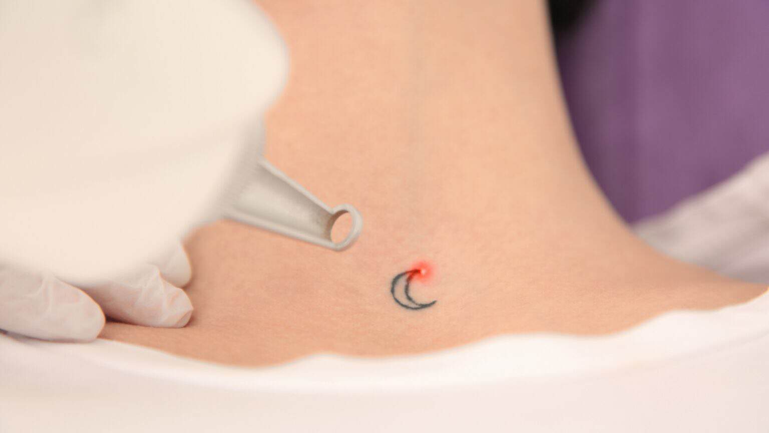 TattooRemoval