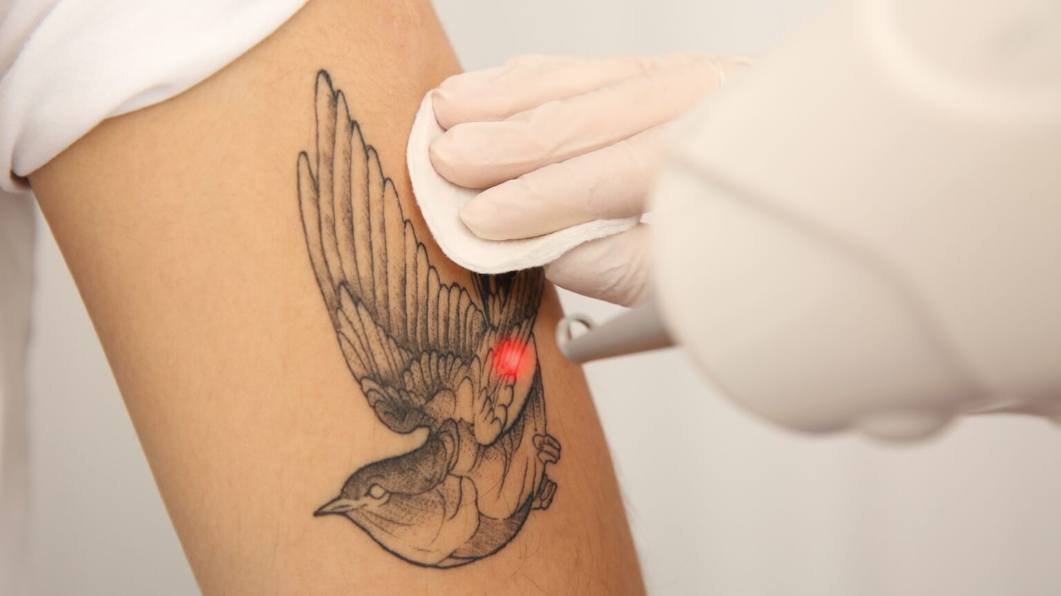 Tattoo Removal Karrinyup & Perth | Laser Tattoo Removal | Luxe Medical Aesthetics