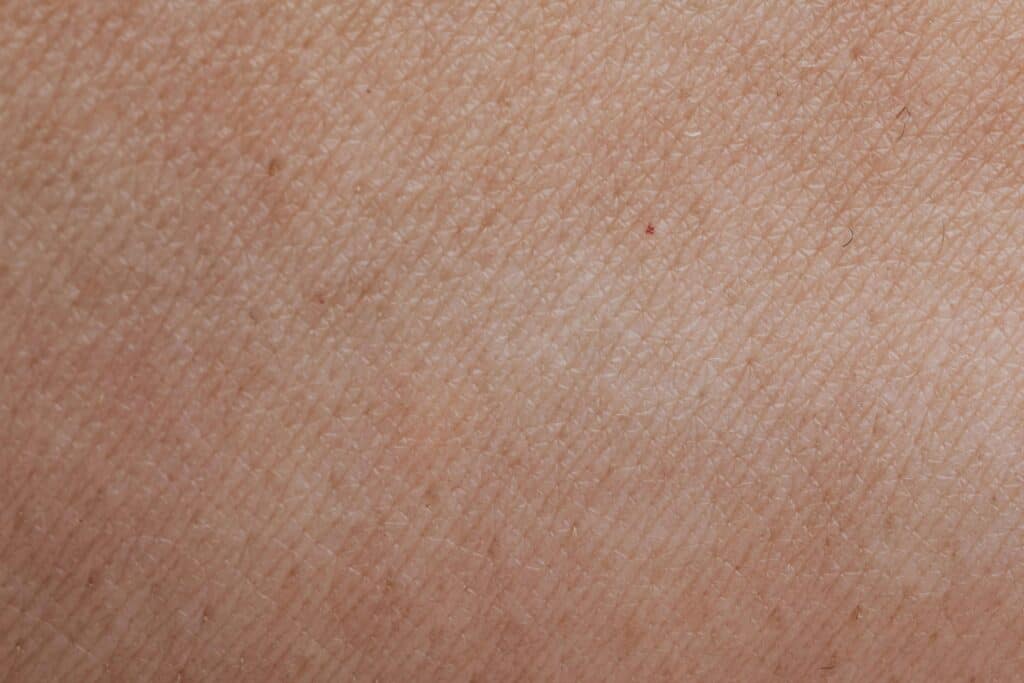 Close-up of sun-induced pigmentation on the skin, treated with laser at Luxe Medical Aesthetics Karrinyup