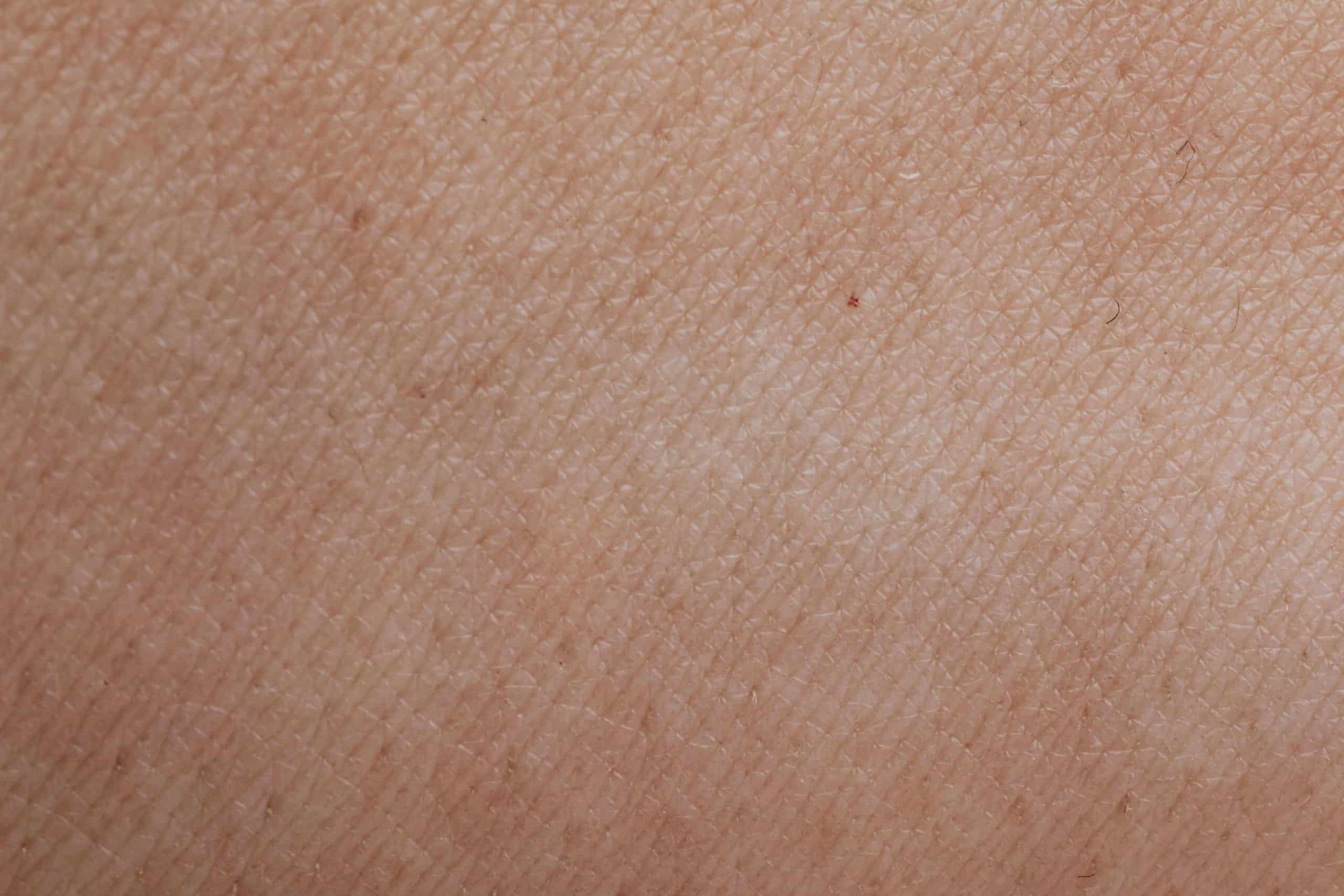 Close-up of sun-induced pigmentation on the skin, treated with laser at Luxe Medical Aesthetics Karrinyup